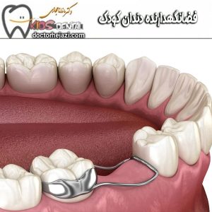 فضانگهدارنده دندان از دکتر ماندانا حجازی ، بهترین دندانپزشک کودکان در تهران