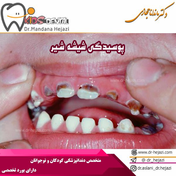 پوسیدگی ناشی از سیر در کودکان