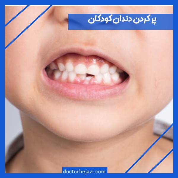 پر کردن دندان کودکان