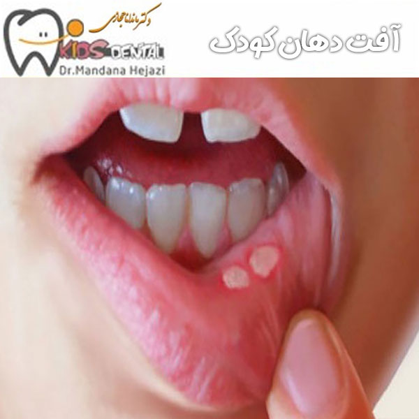 آفت دهان کودک