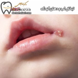 تبخال لب و دهان کودک