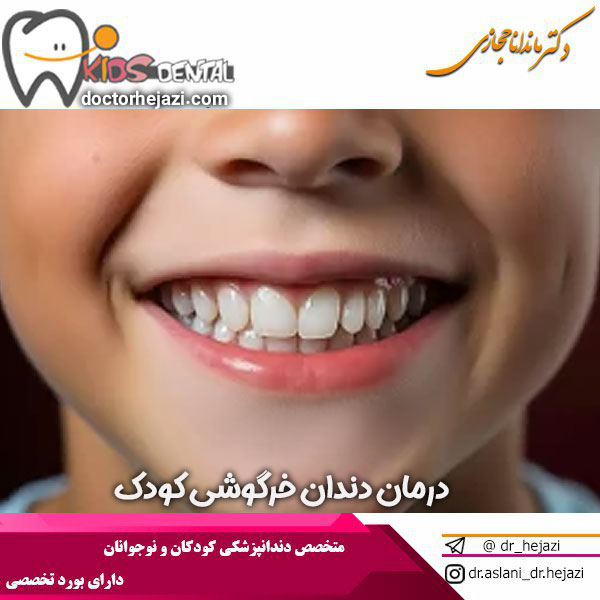 درمان دندان خرگوشی کودک