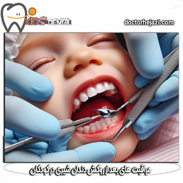 مراقبت های بعد از روکش دندان شیری در کودکان از دکتر ماندانا حجازی ، بهترین دندانپزشک اطفال در تهران
