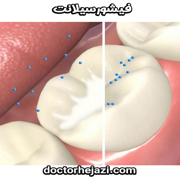 فیشورسیلانت از دکتر ماندانا حجازی متخصص دندانپزشکی کودکان در تهران